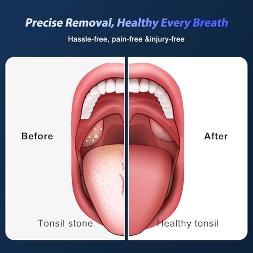 Upgraded Electric Tonsil Stone Remover – High-Precision & Painless Cleaning, Food-Grade Material, 6 Suction Levels | Tonsil Stone Removal Kit with LED Light, Oral Protection & 11 Attachments