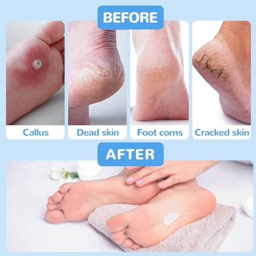 Electric Feet Callus Removers Rechargeable-Foot Scrubber Kit, Wireless Foot File with Metal 2 Grinding Head,3-Speed Pedicure Tools for Feet, Ped Egg for Dead Skin Heels and Hard Cracked Dry Skin
