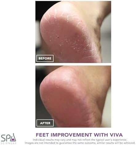 Spa Sciences Viva Most Powerful Pedicure Tool Available-Professional Electronic Foot Smoothing Pedi Tool for Removing Hard, Dry, Cracked Skin/Calluses on Feet, Rechargeable-2 Treatment Heads Included