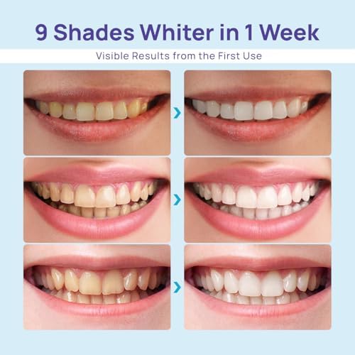 Whitebite Pro Teeth Whitening Kit for Sensitive Teeth – LED Light + 35% Carbamide Peroxide Gel + Remineralizing Gel | Premiuml-Grade Results at Home