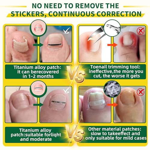 Titanium Alloy Ingrown Toenail Treatment & Removal Kit for Quick Relief, Ingrown Toenail Removal Kit， Professional Ingrown Toenail Corrector, Ingrown Toenail Tools for Quick Relief, 10 Pcs