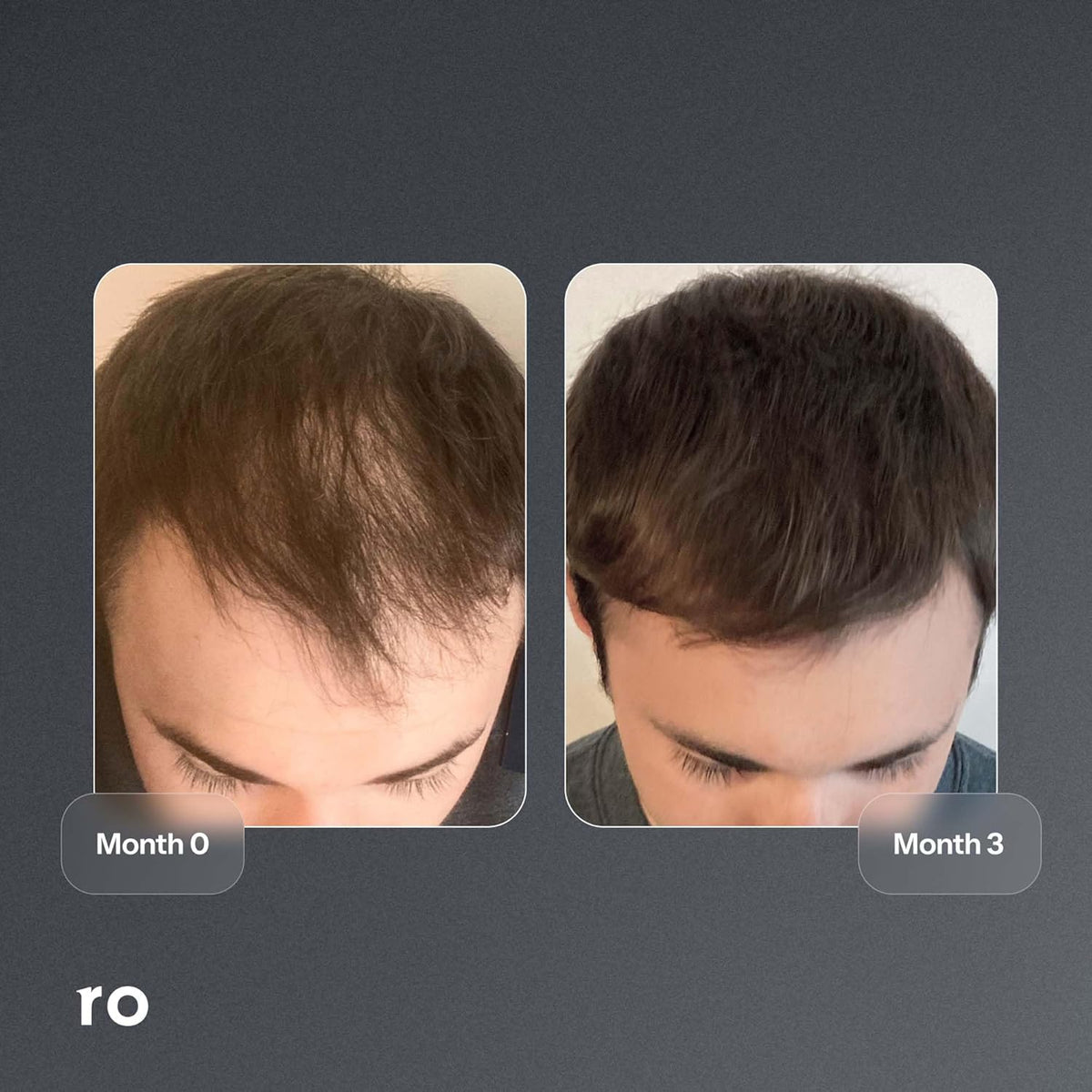 ROMAN Minoxidil 5% Solution for Men's Hair Loss and Regrowth, Unscented Liquid, Clinically Proven, 2 fl oz