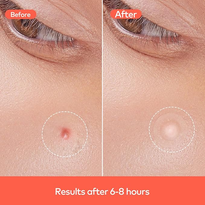 Hydrocolloid Acne Spot Patch for Face – Fast-Acting, Invisible, Healing & Protective, 72 Count